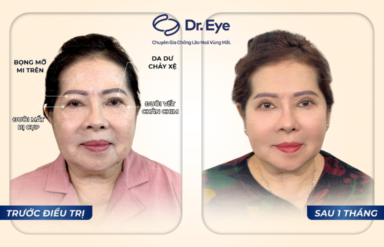 Chỉ sau 1 tháng điều trị tại Dr. Eye, đôi mắt của cô Ngọc Tiên đã vào nếp đều đẹp, không có dấu hiệu sưng đau hay bầm tím. 