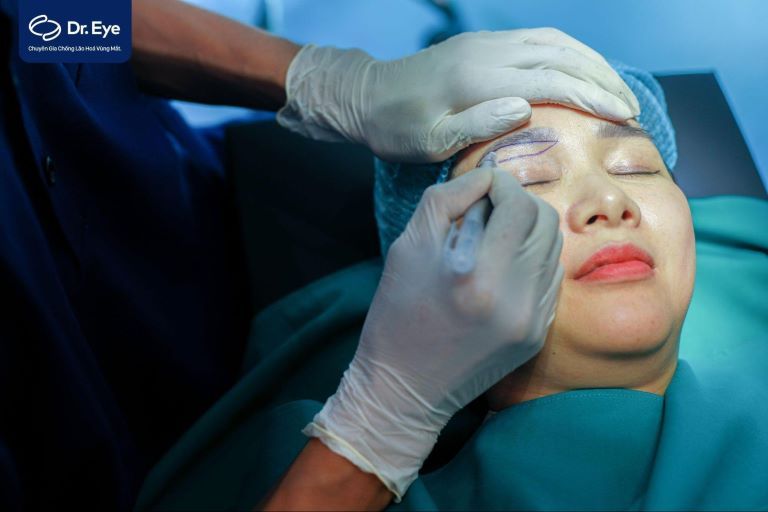 chữa sụp mí