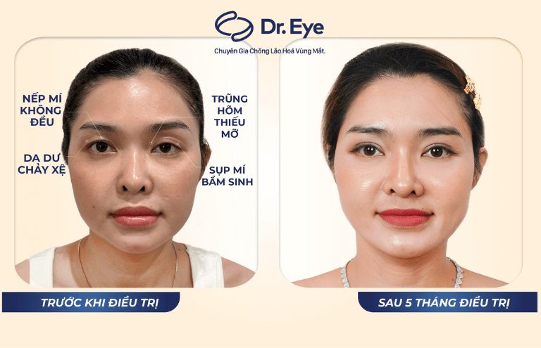 cách làm mắt hết sụp mí