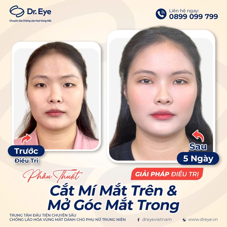 phẫu thuật cắt mí mắt trên và mở góc mắt trong