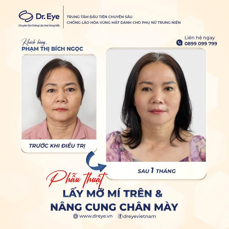 phẫu thuật lấy mỡ mí trên và nâng cung chân mày