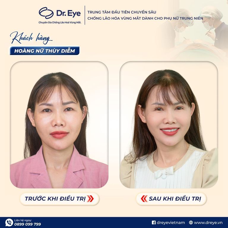 cắt mí mắt có cần kiêng ăn mướp đắng không