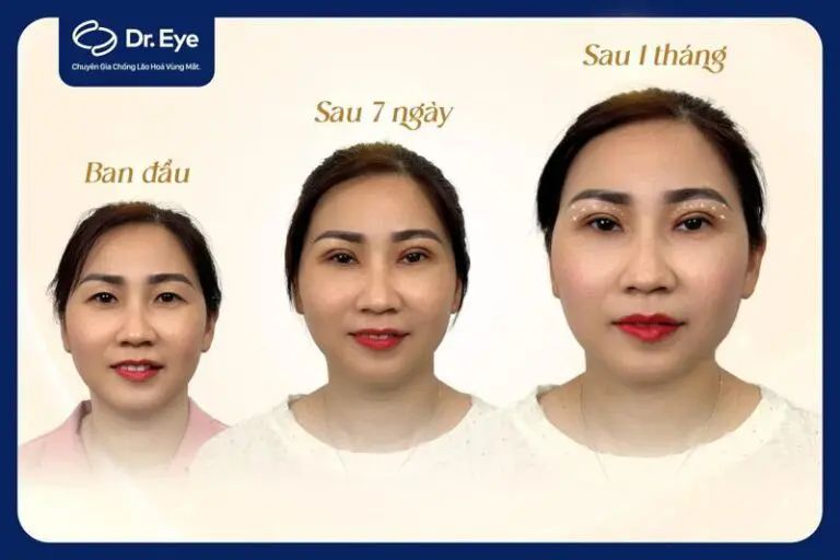 cắt mí uống sữa đậu nành được không