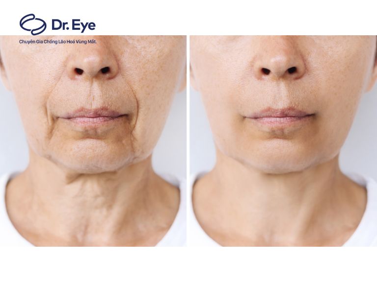 nguyên nhân da cổ chảy xệ