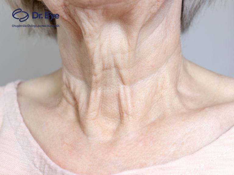 Da cổ chảy xệ do đâu? Cách khắc phục và ngăn ngừa hiệu quả