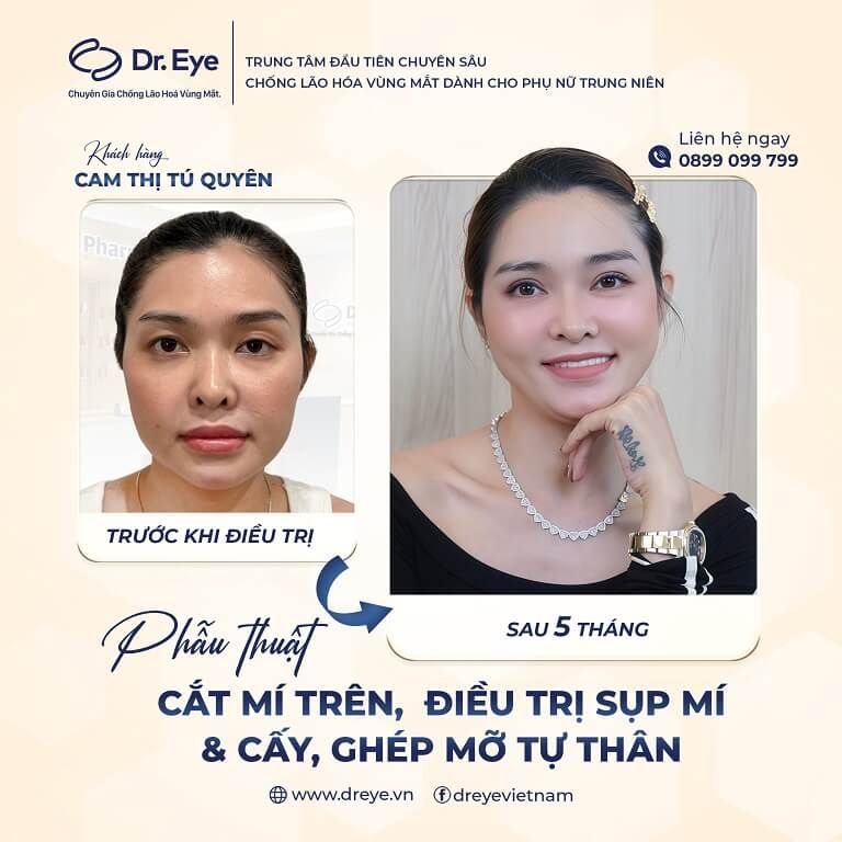 mắt đa tình có tốt không