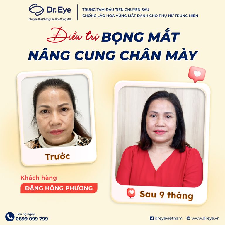 điều trị bọng mắt và nâng cung chân mày