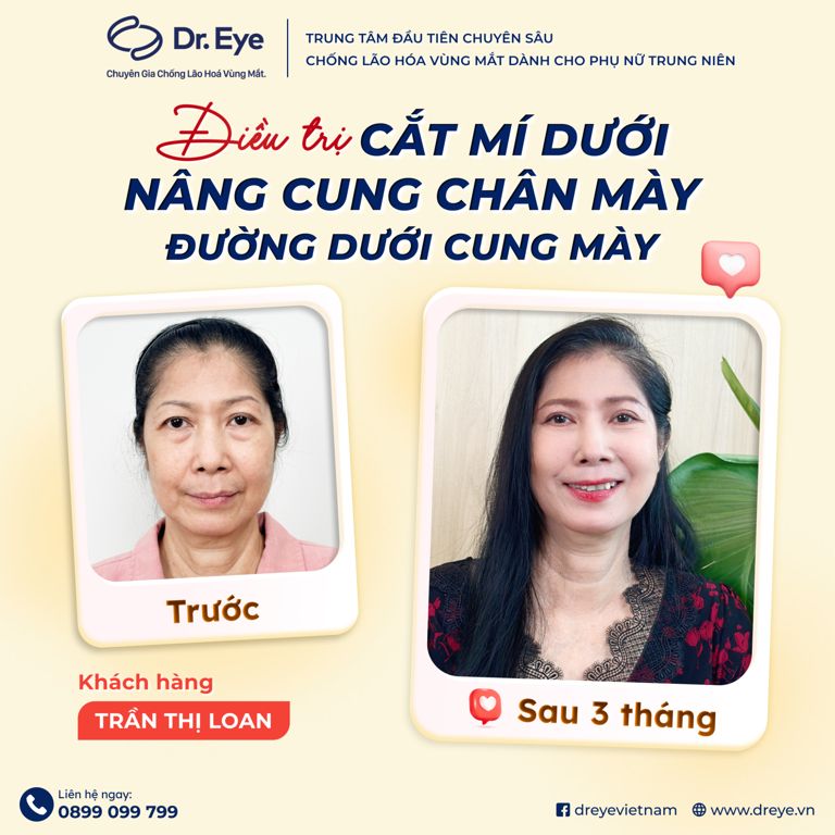 điều trị cắt mí dưới, nâng cung chân mày