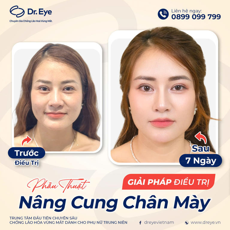 Phẫu thuật nâng cung chân mày