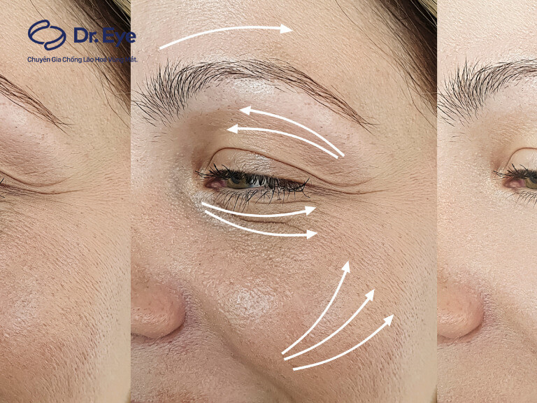Căng chỉ collagen vùng mắt là gì và có an toàn không? 