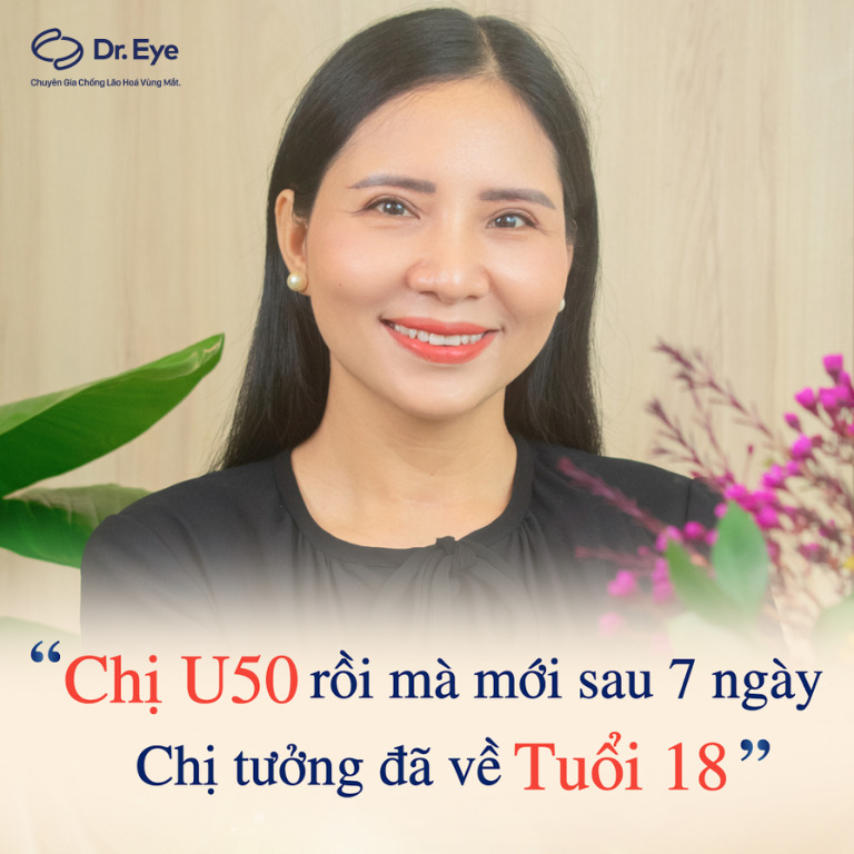 5 tháng sau khi cắt mí tại Dr. Eye