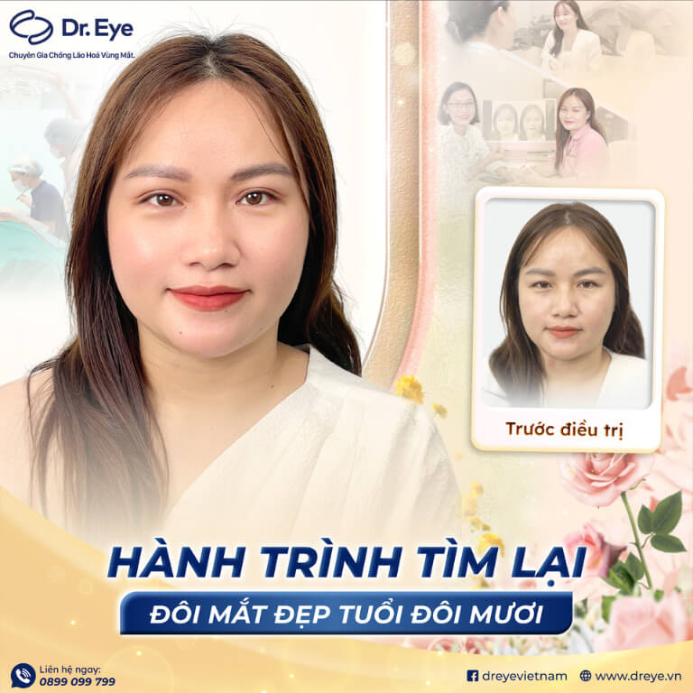 Khách hàng cắt mí tại Dr.Eye
