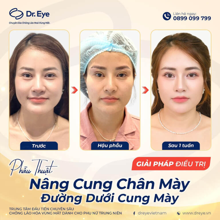 Khách hàng nâng cung chân mày tại Dr.Eye