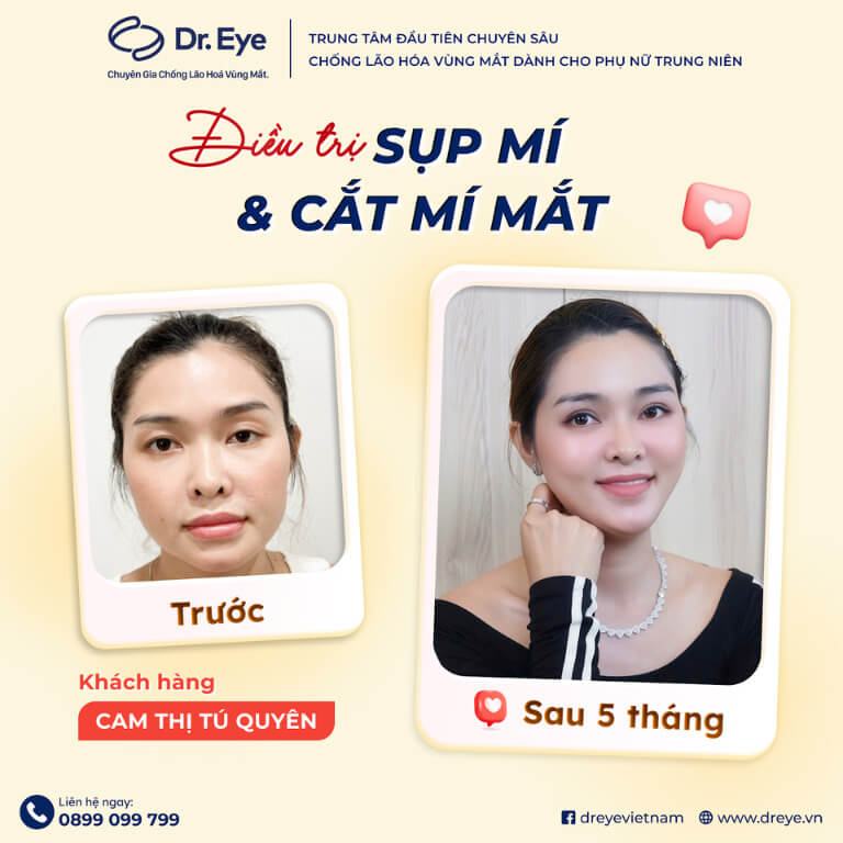 Điều trị sụp mí và cắt mí mắt tại phòng khám Dr.Eye