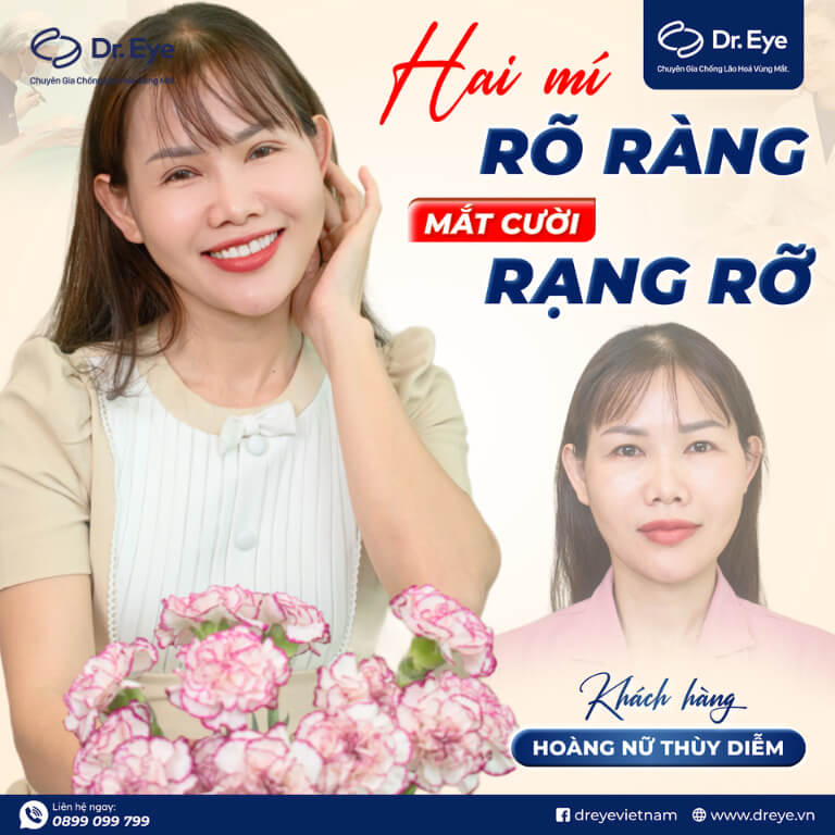 Cắt mí - chỉnh sửa mí lỗi tại Dr.Eye
