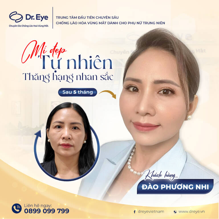 Cắt mí tự nhiên tại Dr.Eye