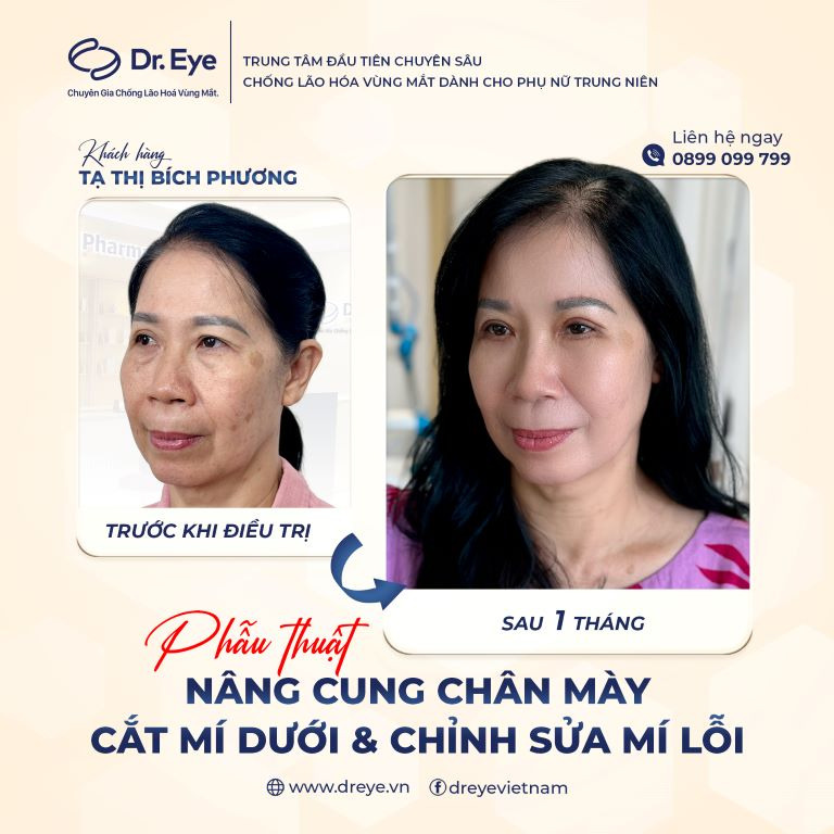 Nâng cung chân mày, cắt mí dưới tại Linh Anh