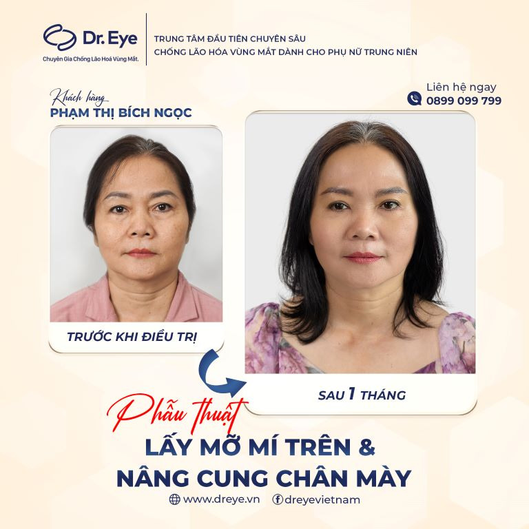 Lấy mỡ mí và nâng cung chân mày tại Linh Anh