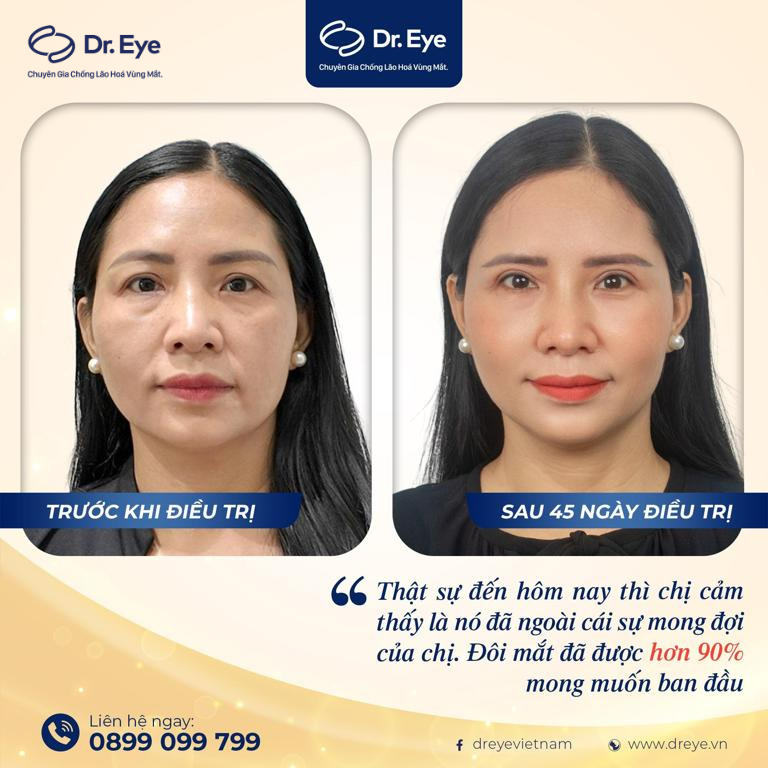 Cắt mỡ mí và nâng cung chân mày tại Linh Anh