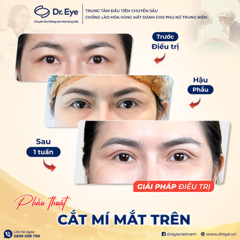 Cắt mí trên tại Dr. Eye