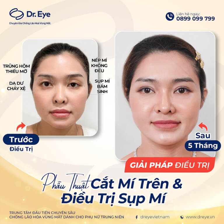 Điều trị sụp mí tại Dr. Eye
