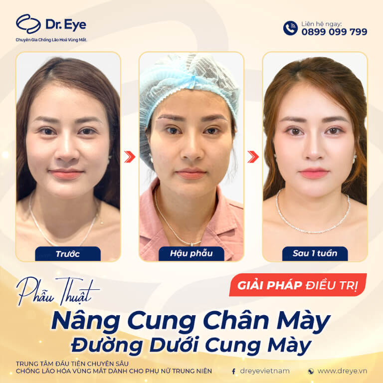 Nâng cung chân mày tại Dr. Eye