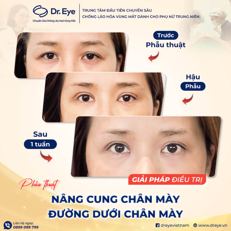 Nâng cung chân mày đường dưới chân mày