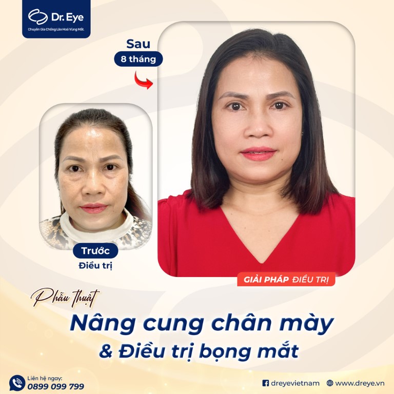 Nâng cung chân mày thành công tại Dr. Eye