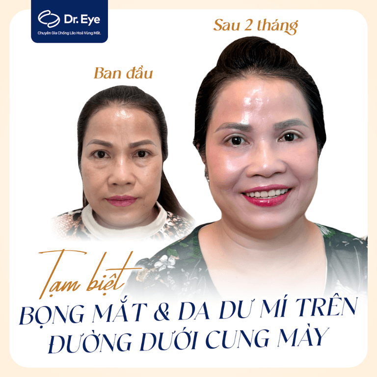 Nâng cung chân mày thành công tại Dr. Eye