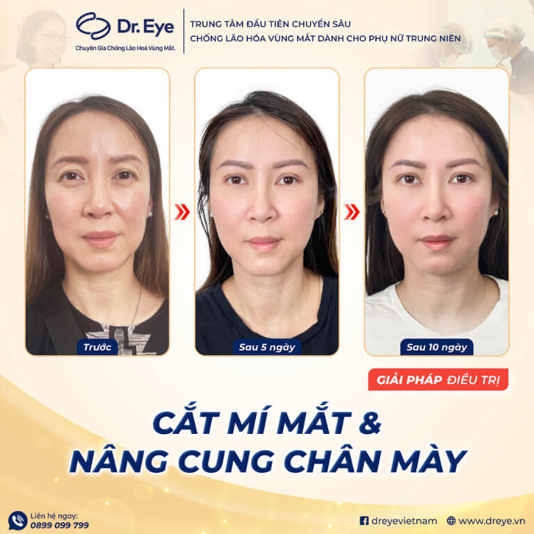 Nâng cung chân mày và cắt mí mắt tại Dr. Eye
