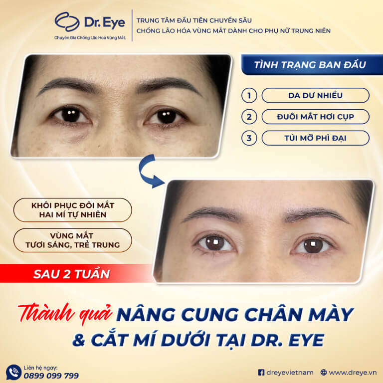 Nâng cung chân mày và cắt mí dưới
