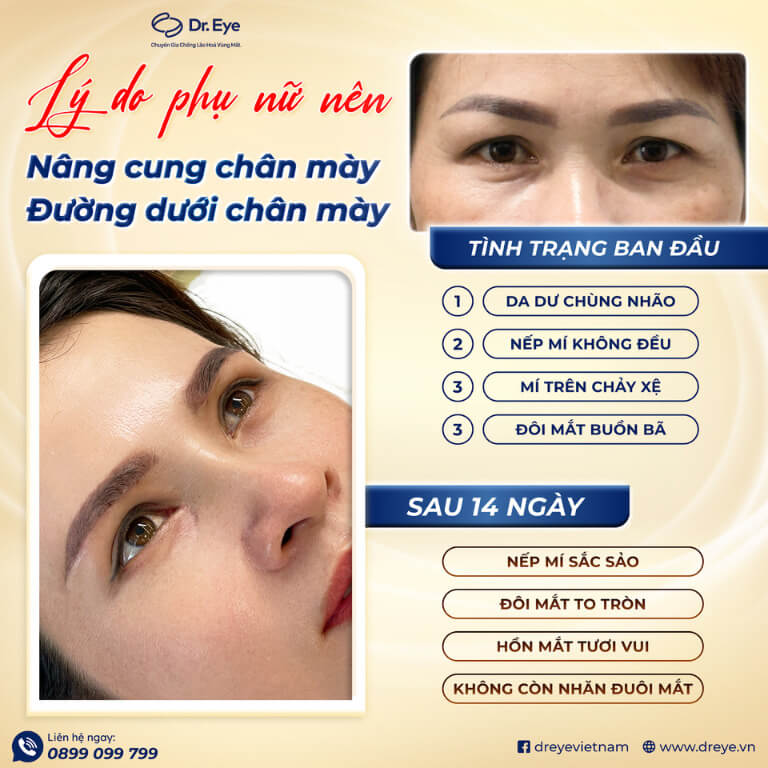 Nâng cung chân mày tại Dr. Eye