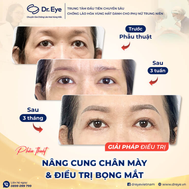 Nâng cung chân mày và trị bọng mắt