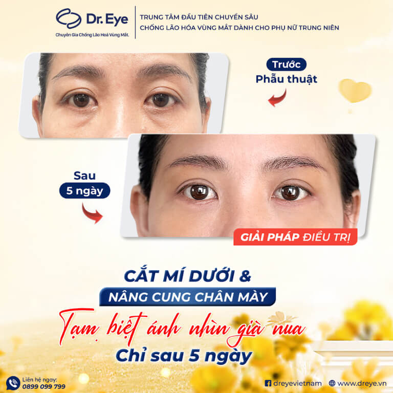 Cắt mí dưới tại Dr. Eye
