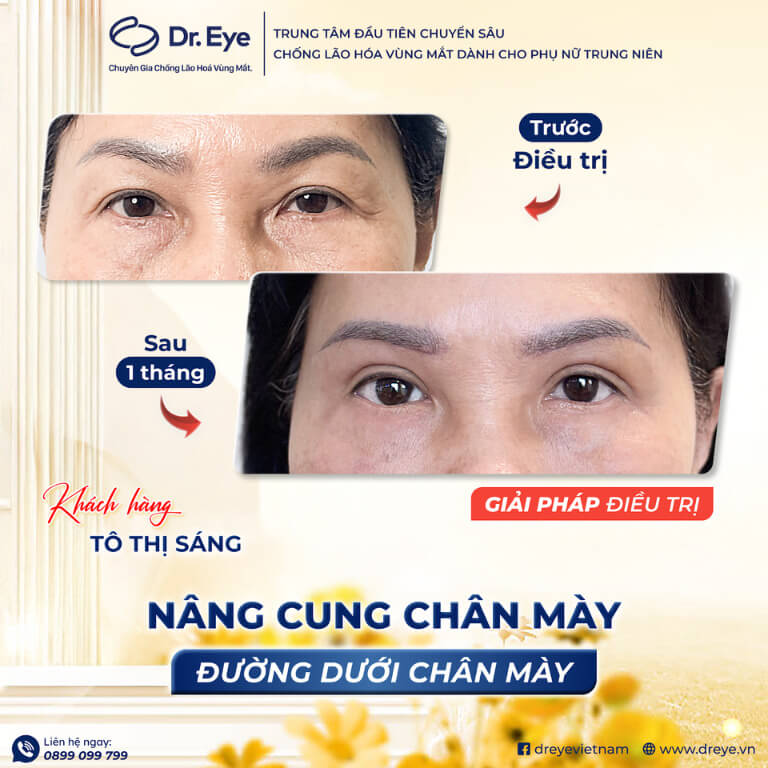 Nâng cung chân mày tại Dr. Eye