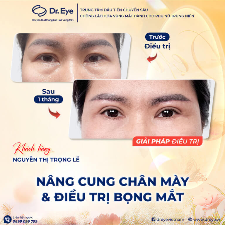 Nâng cung mày và điều trị bọng mắt