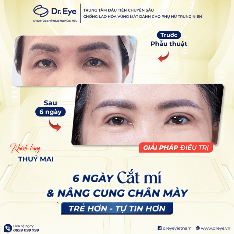 Cắt mí và nâng cung chân mày