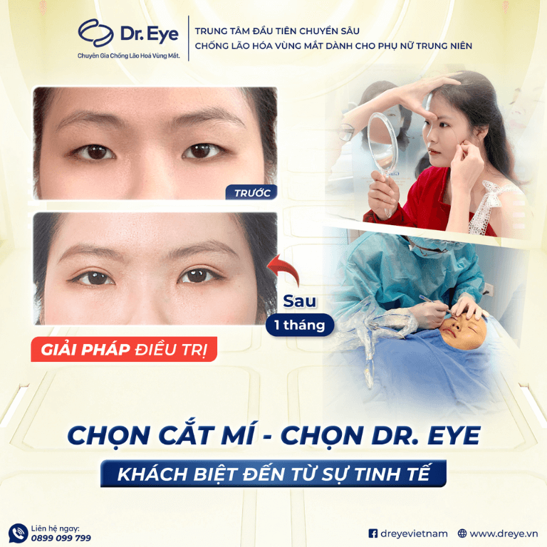 Khách hàng cắt mí tại Dr. Eye