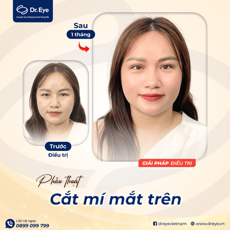 Cắt mí mắt trên tại Dr. Eye