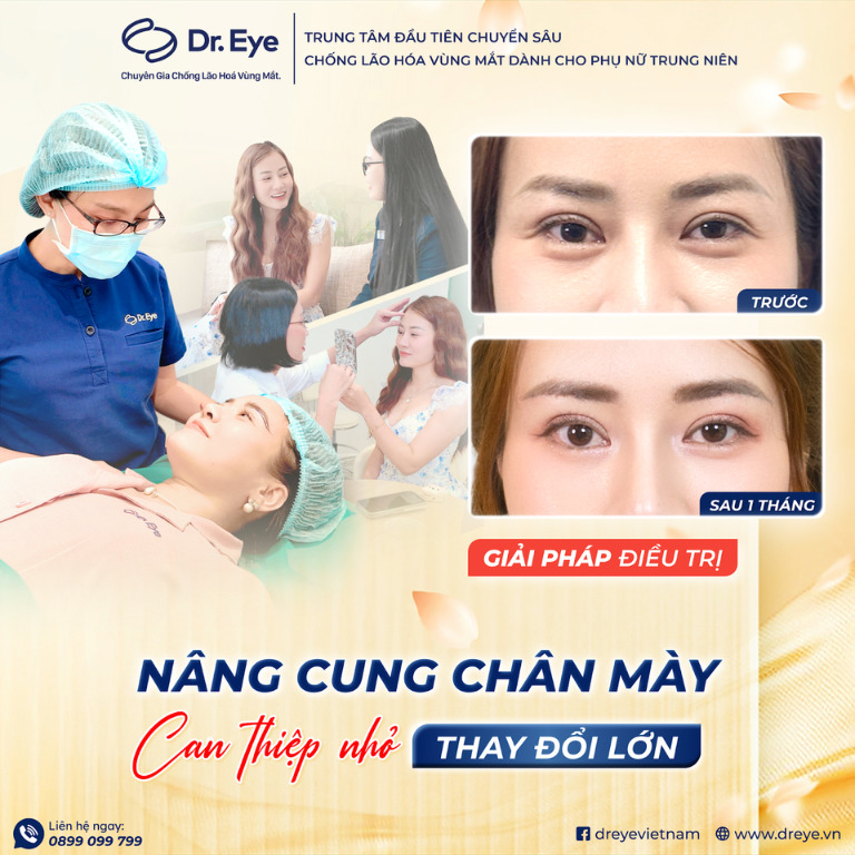 Nâng cung chân mày tại Dr. Eye