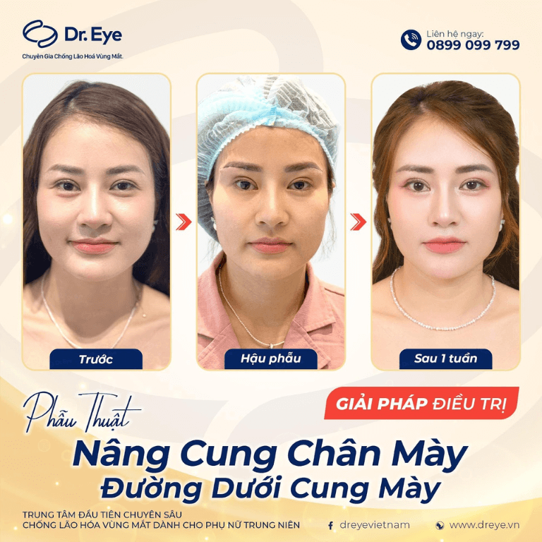 Nâng cung chân mày tại Dr. Eye