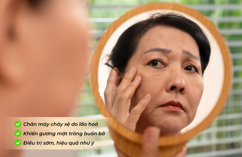 Nâng cung chân mày thấp, chảy xệ