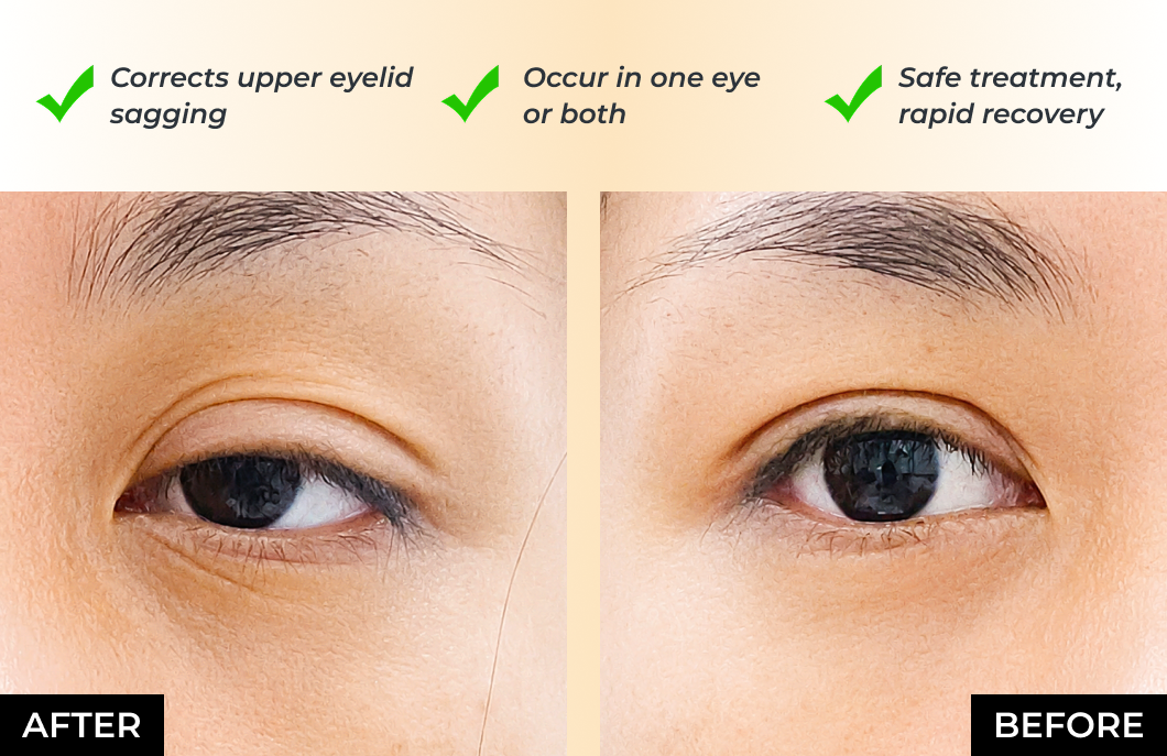 Ptosis Correction