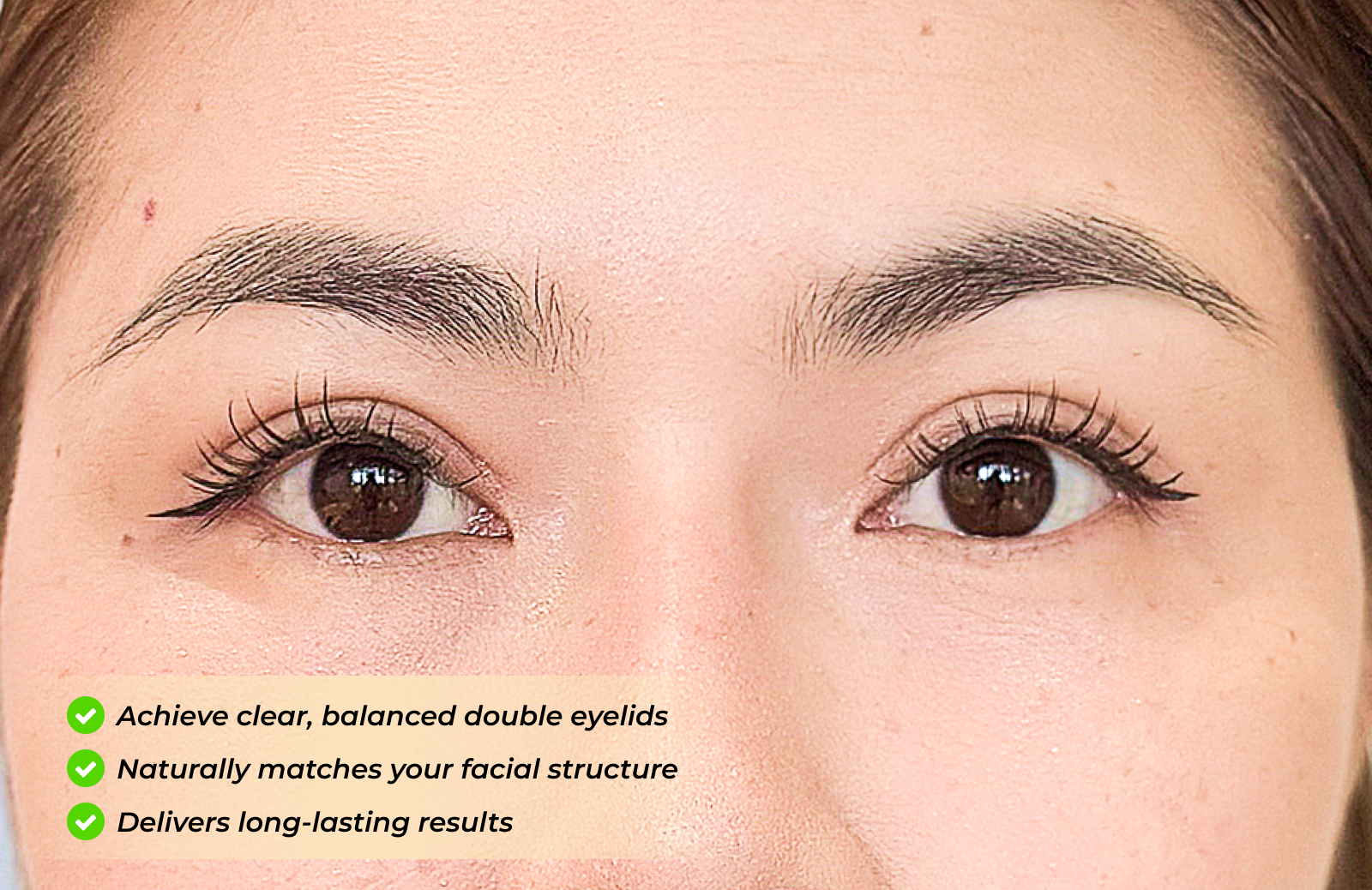 Solutions for uneven double eyelids, monolids, and hidden eyelid creases