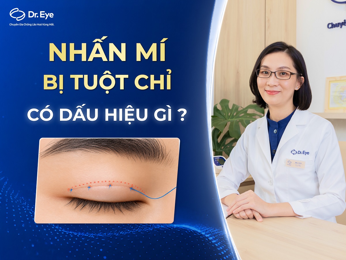 Nhấn mí bị tuột chỉ có dấu hiệu gì? Cách xử lý phù hợp