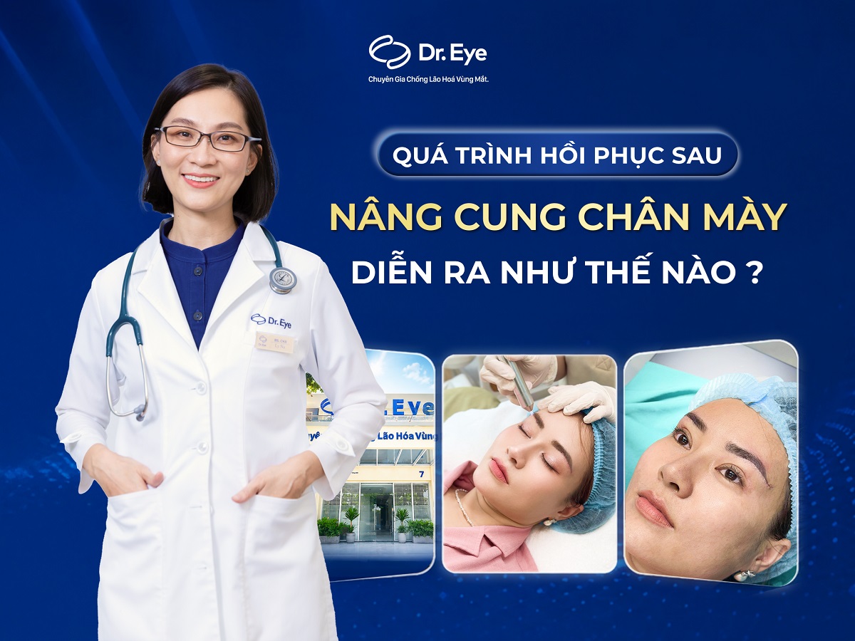 Quá trình hồi phục sau nâng cung chân mày thế nào?