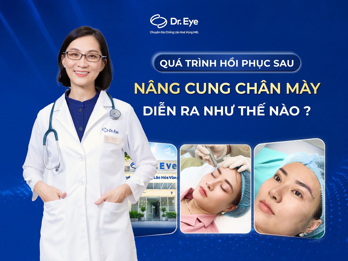 Quá trình hồi phục sau nâng cung chân mày thế nào?