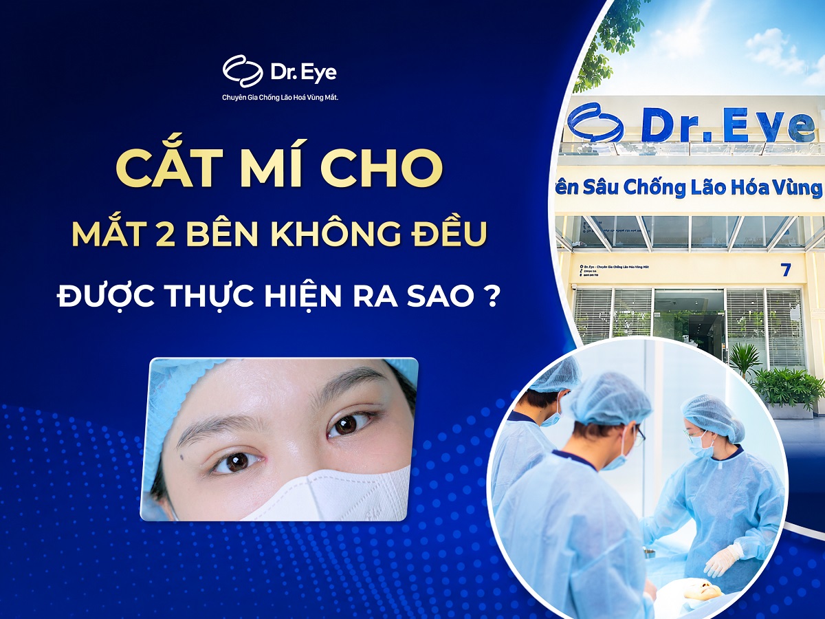 Cắt mí cho mắt hai bên không đều được thực hiện ra sao?