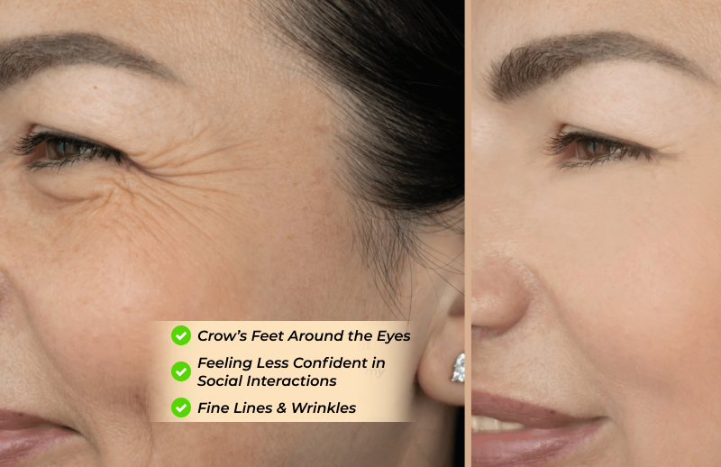 Remove wrinkles around the eye area