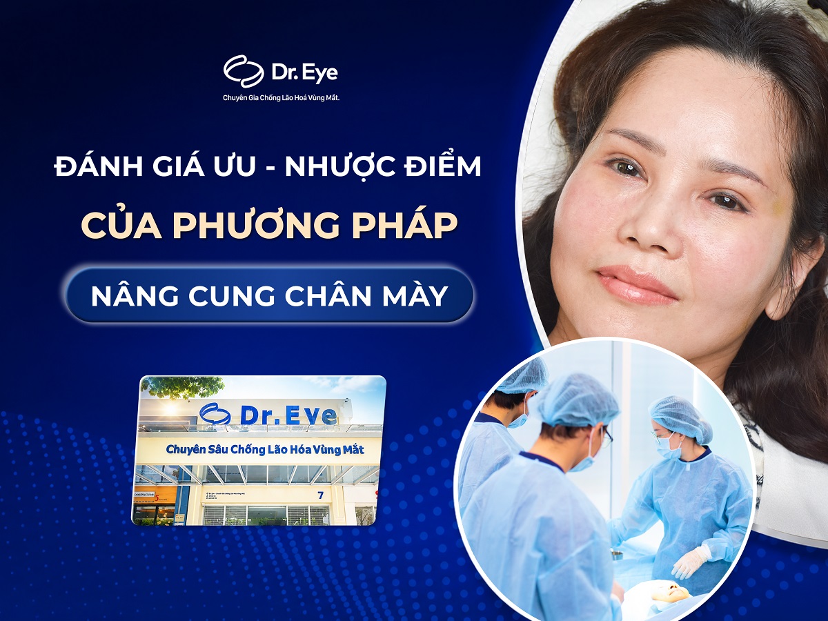Đánh giá ưu nhược điểm nâng cung chân mày